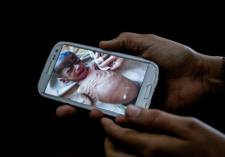 A doctor shows on her mobile phone a photo of Fadl, an 8-month-old Yemeni boy taken in his last days before he starved to death, in this Feb. 10, 2018 photo at a hospital in Mocha, Yemen. 