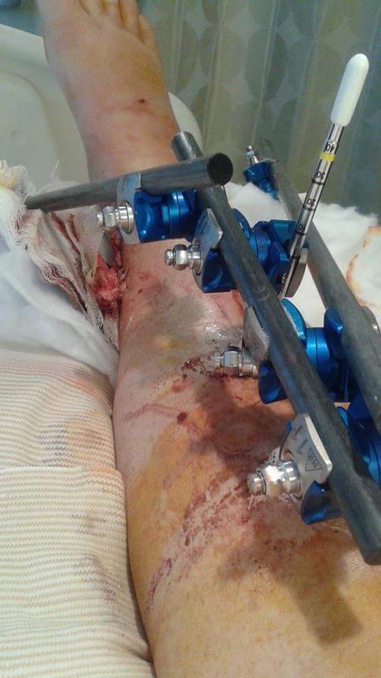 Beth Collins has undergone 10 leg surgeries