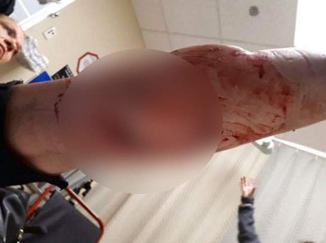 A Mission woman needed 85 staples in her leg to close wounds from a dog attack in Langley Tuesday night.