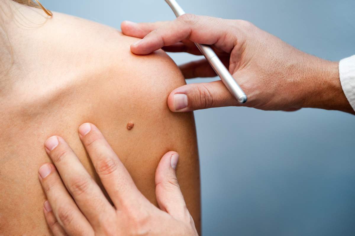 Melanoma is the most deadliest form of skin cancer. Here are the warning signs you need to look out for. 