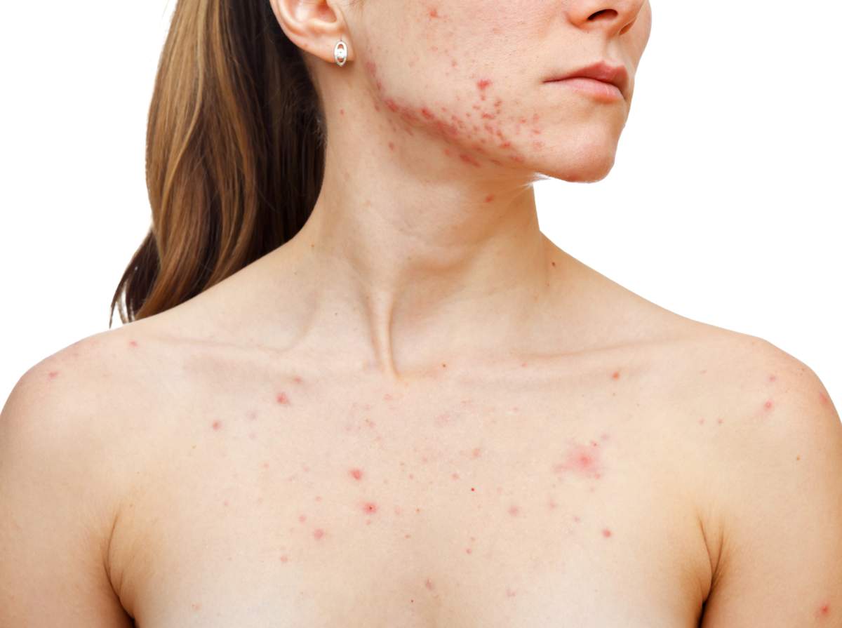 A recent piece from the New York Times suggests acne may be "cool," but some think it's just easier to share your skin struggles on social media. 