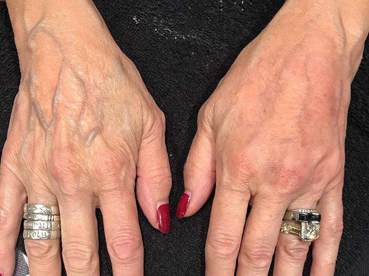 A before and after shot using Radiesse dermal filler.