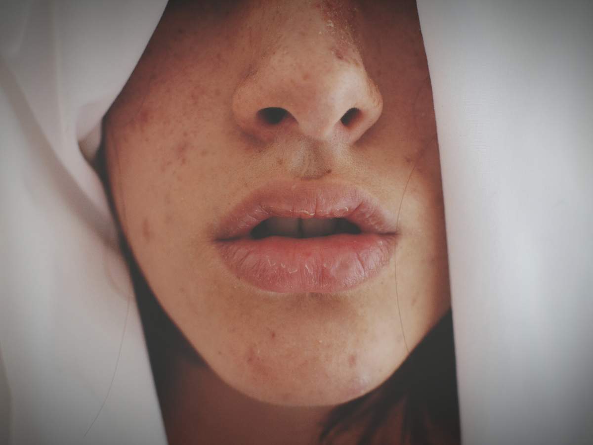 The keto diet might produce great weight loss results, but its effects on skin can be less than desirable. 