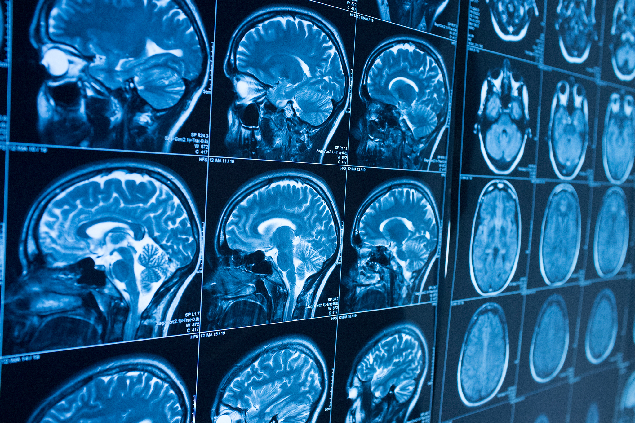 Images of a brain of a person with MS. 
