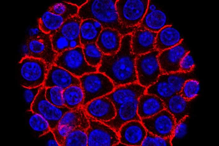 In a rare triumph for tough-to-beat pancreatic cancer, patients who had surgery lived substantially longer on a four-drug combo than on a standard cancer drug, according to research released on Monday, June 4, 2018. 