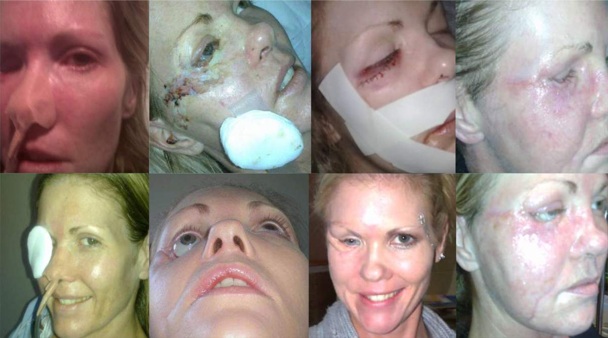A collage of different stages of Vanessa Carter’s recovery over nine years is shown in a handout photo. Results from various surgeries and complications as well as the damage the infection made after eating much of the tissue away under the eye. THE CANADIAN PRESS/HO-Vanessa Carter MANDATORY CREDIT
