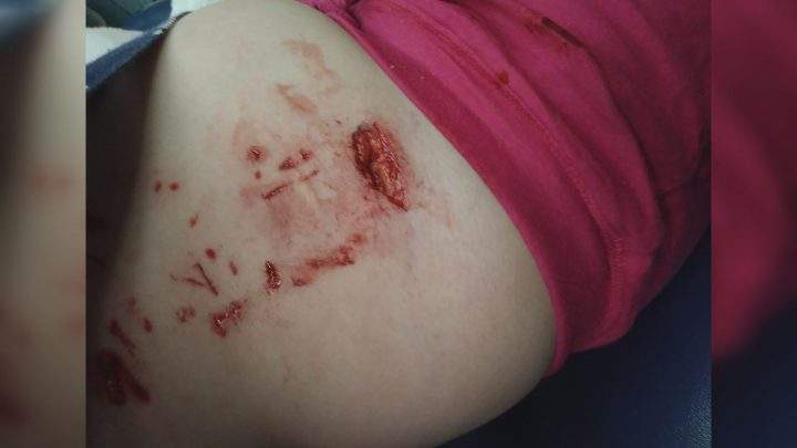 Autumn Clifford needed nine to 12 stiches in her torso, according to her father.