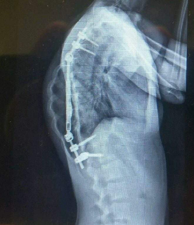 An X-ray of Jessica Robb’s back produced after the Apifix procedure.