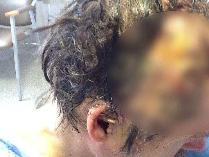 ‘My scalp tore and it dropped me’: Bella Coola man describes grizzly bear attack - image