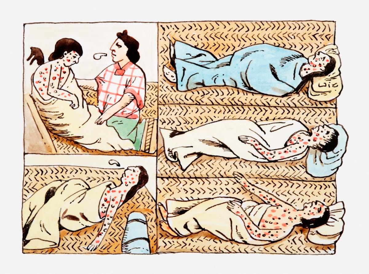 Illustrations of Aztec’s suffering from smallpox virus spread by the Spanish.