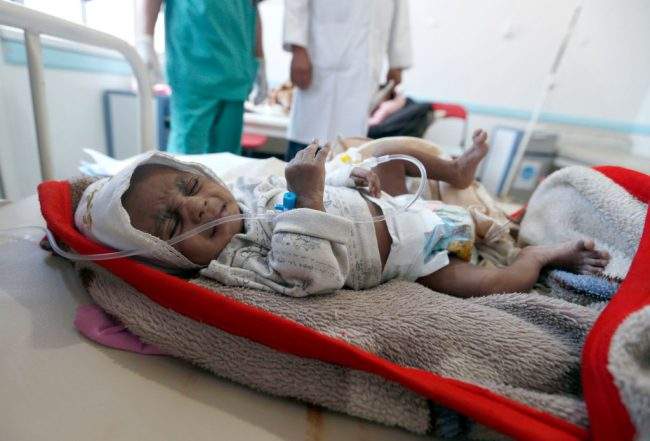 A Yemeni child suspected of being infected with cholera receives treatment at a hospital in Sanaa, May 25, 2017.
