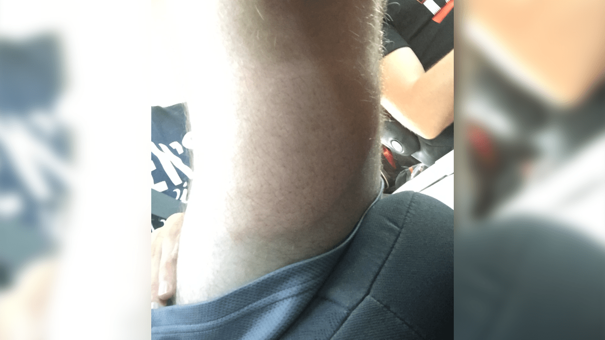 Kingston Ponies pitcher snaps a photo of the swelling on his leg from a bug bite. He was in hospital shortly after and still made it in time to ensure a win for the Ponies.