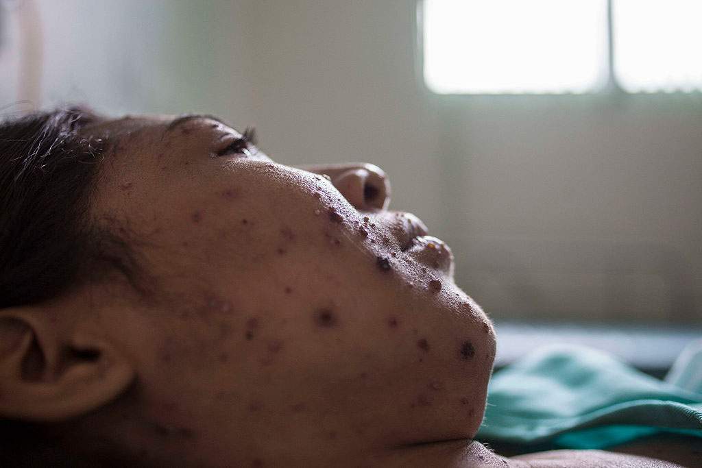 FILE - Measles, a highly contagious infection caused by the measles virus is an airborne disease which spreads easily through the coughs and sneezes of those infected.