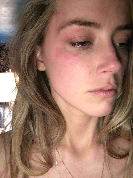 Amber Heard admits to ‘hitting’ Johnny Depp in recording - image