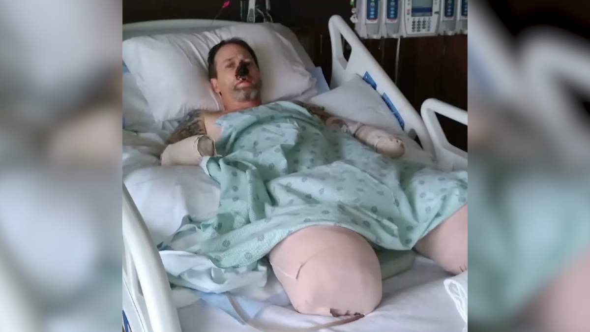 Dog owner’s limbs amputated after contracting rare infection from lick - image