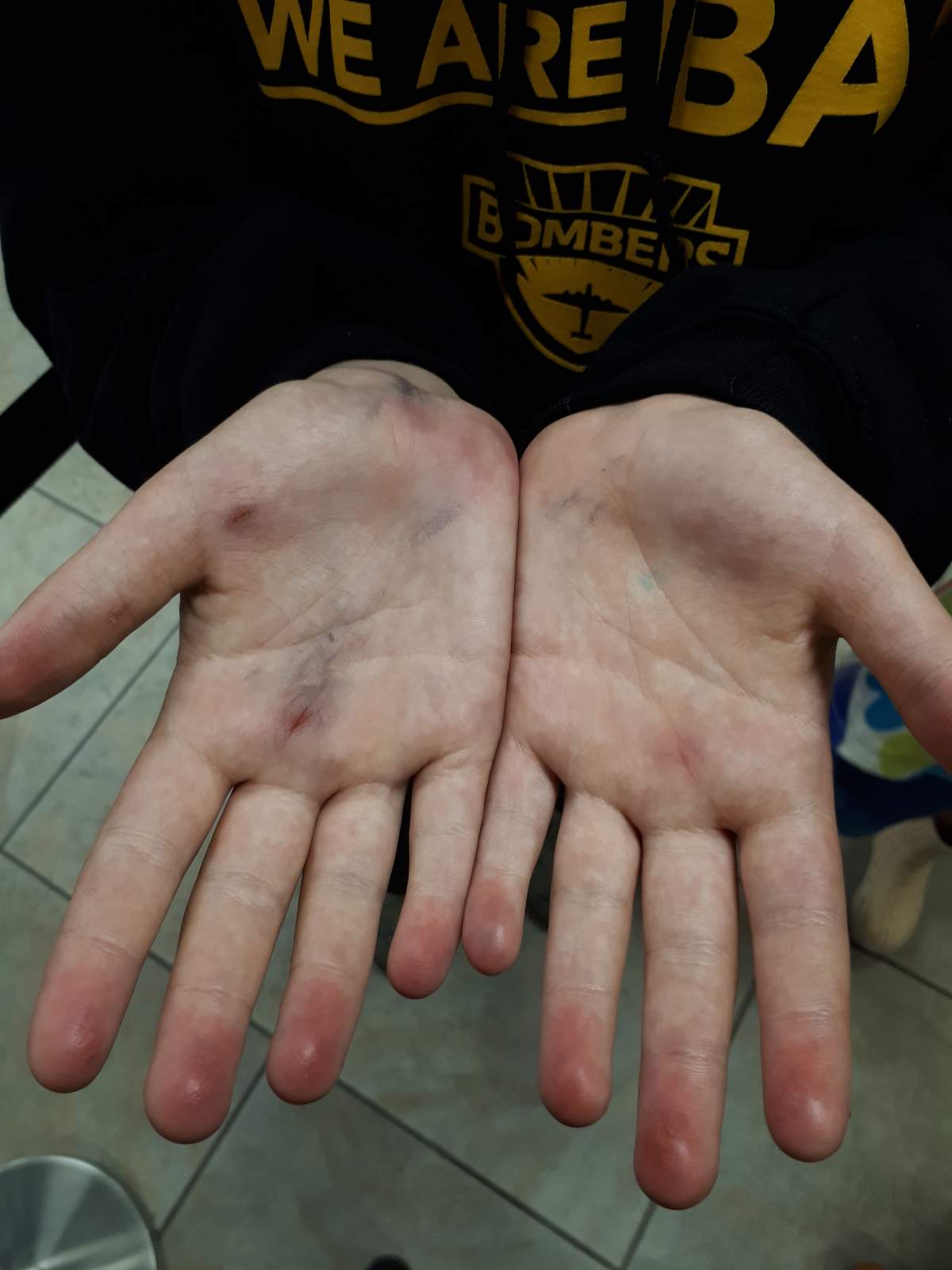 Calgary mother, Trina Pentony, said this is a photo of her 10-year-old daughter’s injuries after playing at the newly opened Prairie Winds spray park in August 2018.