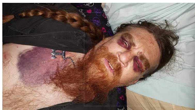A Bowen Island man is recovering from serious injuries following an alleged road rage attack.