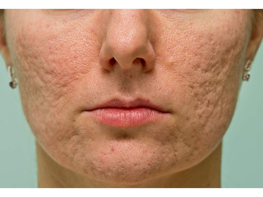 Acne scars form when inflammation causes changes in your skin's collagen. But they're not necessarily irreversible. 
