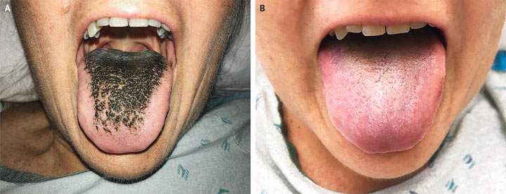 A before and after photo of the woman who had black hairy tongue.