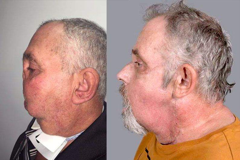 He is able to breathe without a tracheotomy, chew with his new jaws and also smell and speak properly.