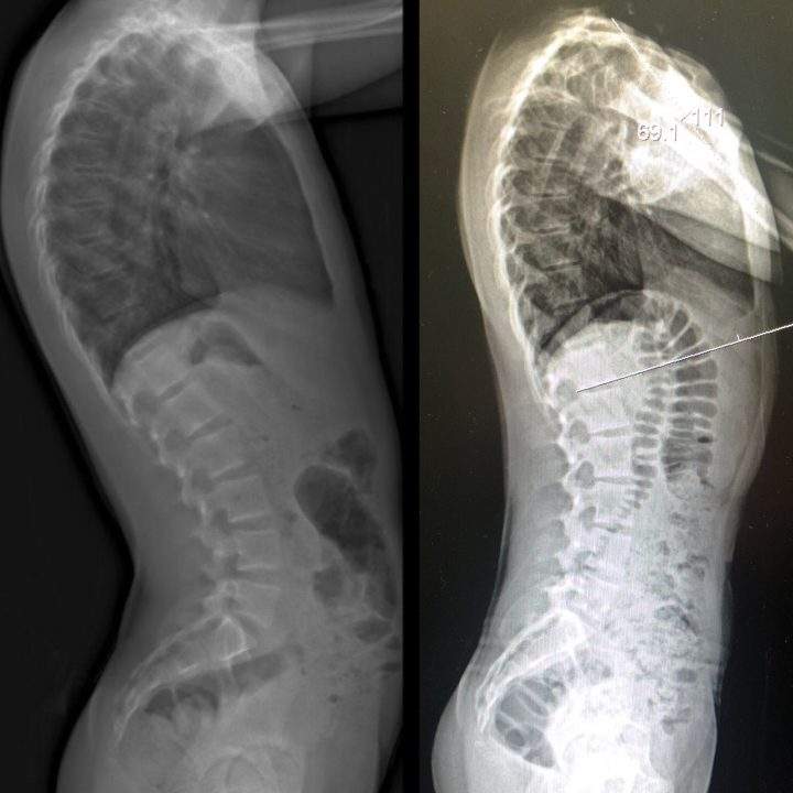 Saskatchewan family pushes for the province to modernize its back braces - image
