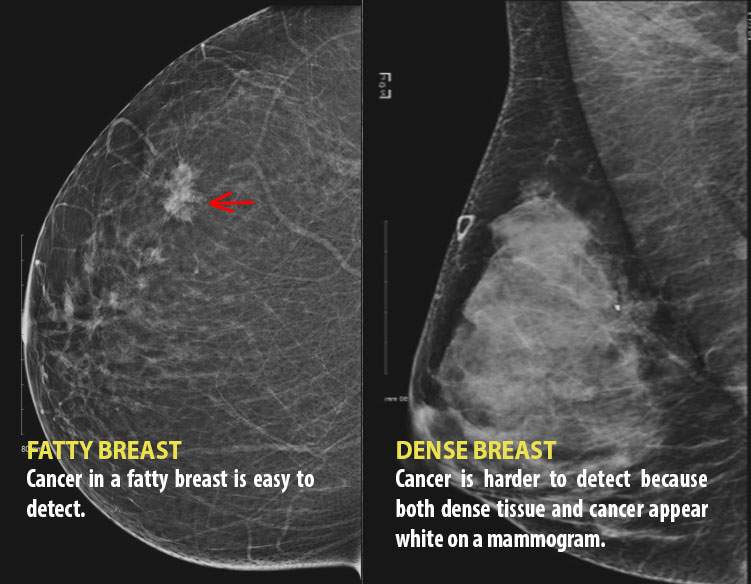 We need to talk about dense breasts: Why governments are taking notice - image