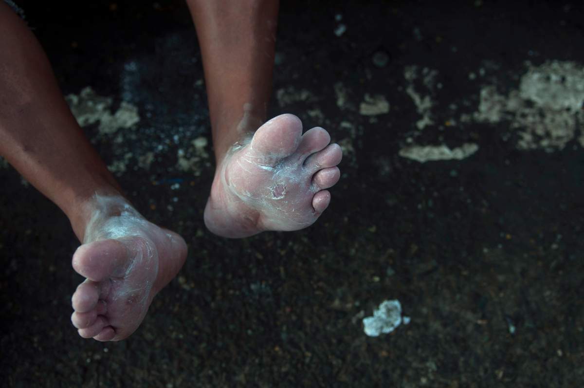 A Honduran migrant shows his blistered feet covered in talcum powder in Tecun Uman, Guatemala, Sunday, Oct. 21, 2018.