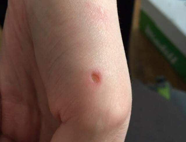 Amelia’s hand after she was bitten by Honey.