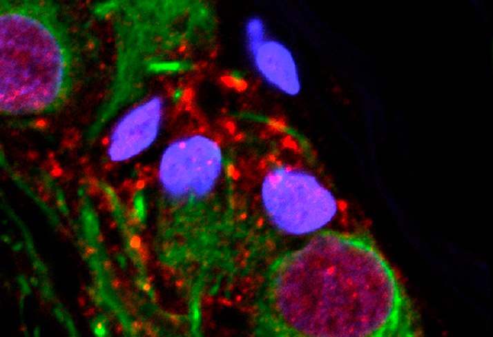 This microscope image provided by the Van Andel Research Institute in October 2018 shows an abnormal protein that is a hallmark of Parkinson's disease clumped inside the appendix.