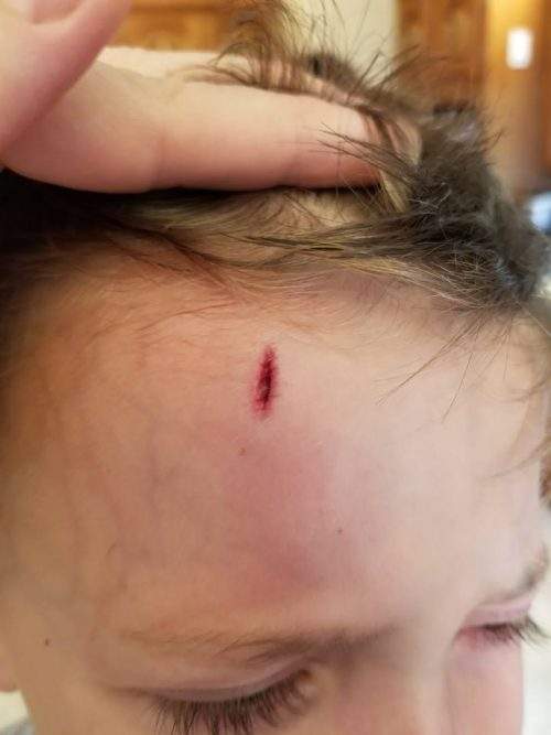 Mom Erin Spooner has three boys and they each ended up in the emergency department for various injuries over the course of five days last week.