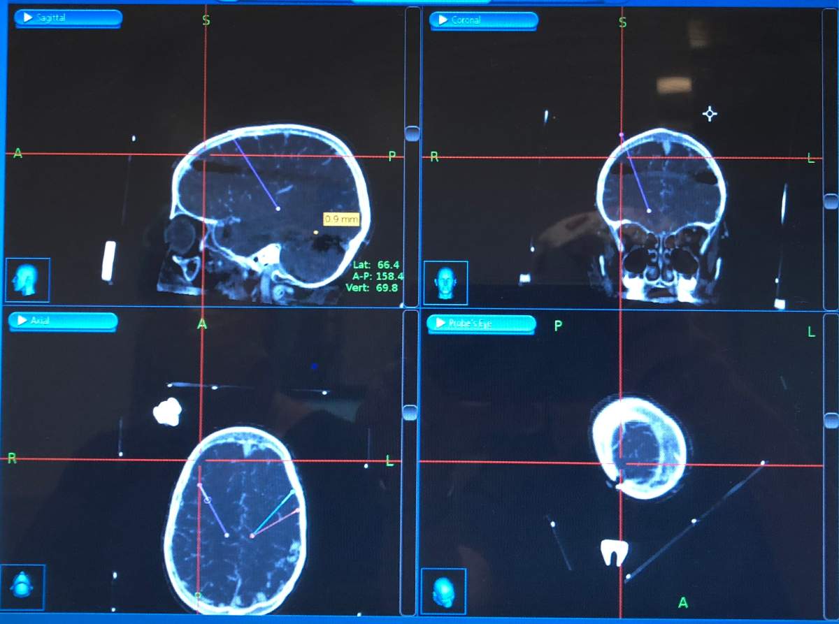 Neurosurgeons from The Hospital for Sick Children and Toronto Western Hospital carefully placed electrodes into the brain of 9-year-old Andi Dreher. The operation, which they hope will help treat her drug-resistant epilepsy, marks the first time a Canadian child has been treated using deep brain stimulation.