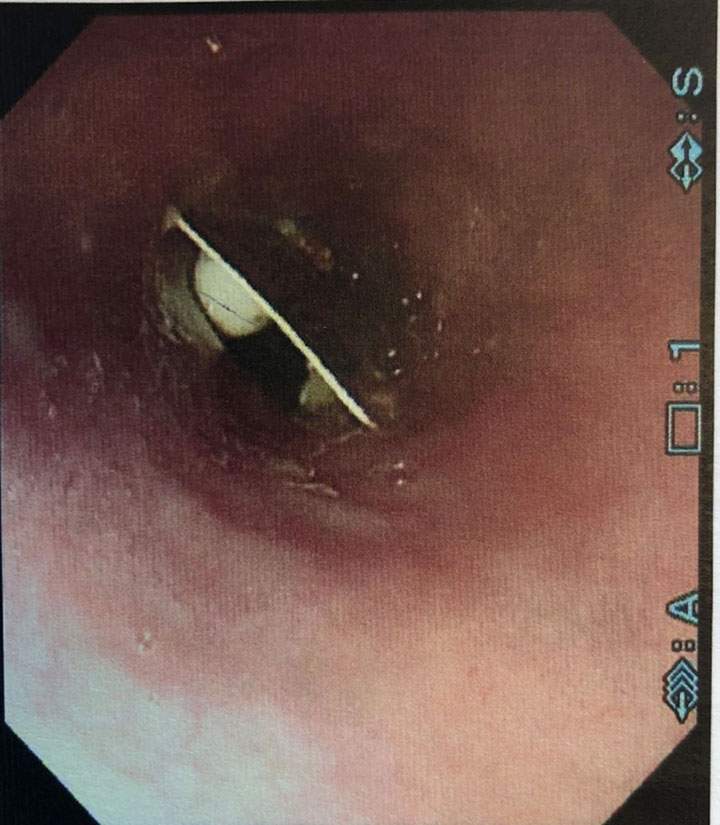 Endoscopic image of a packet of pills lodged in a woman’s throat.