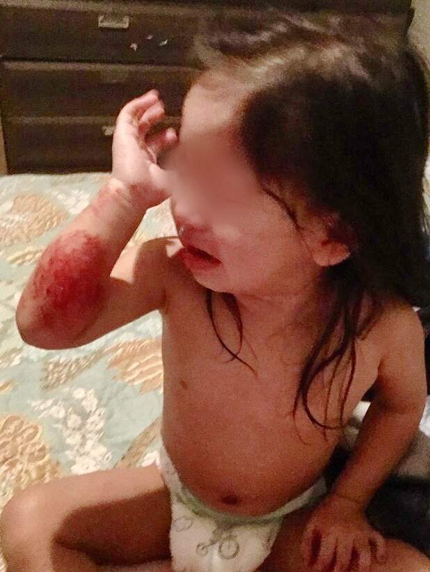 Officials say the rashes are caused by black mould growing in homes.