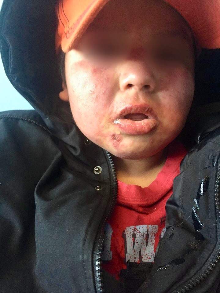 Some children are have red rashes on their skin.