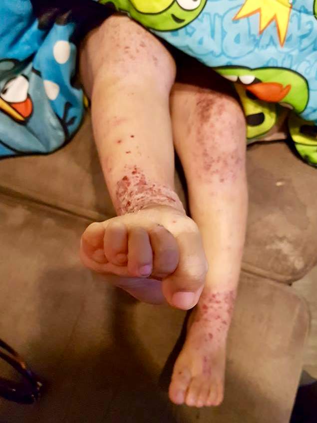 Cat Lake First Nation officials say children are sick after exposure to mould.