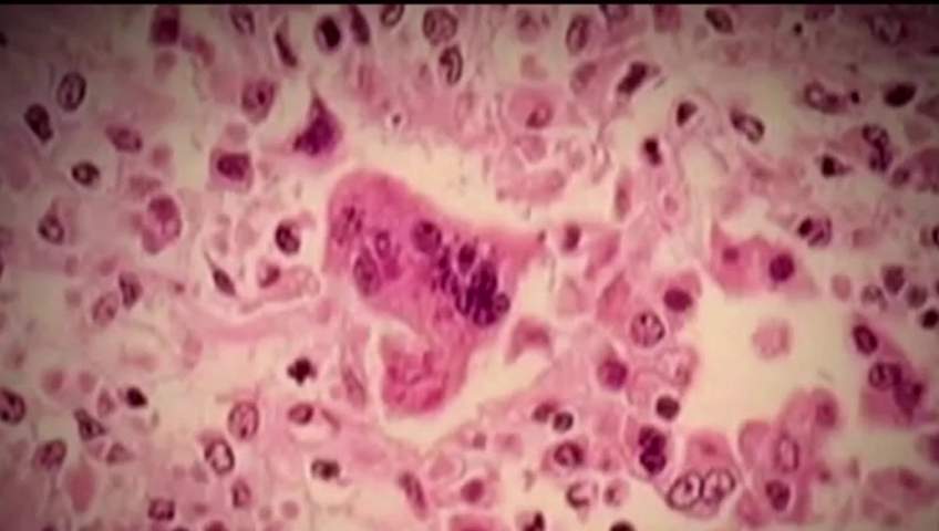 Toronto Public Health is investigating two confirmed cases of measles and warning that some people may have been exposed to the highly contagious virus.