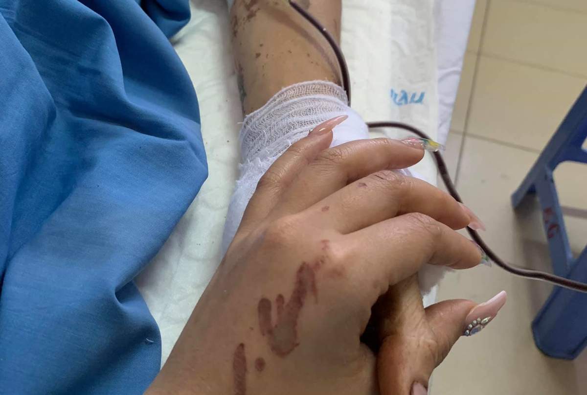 B.C. couple face long recovery after ‘life-changing’ acid attack in Vietnam - image