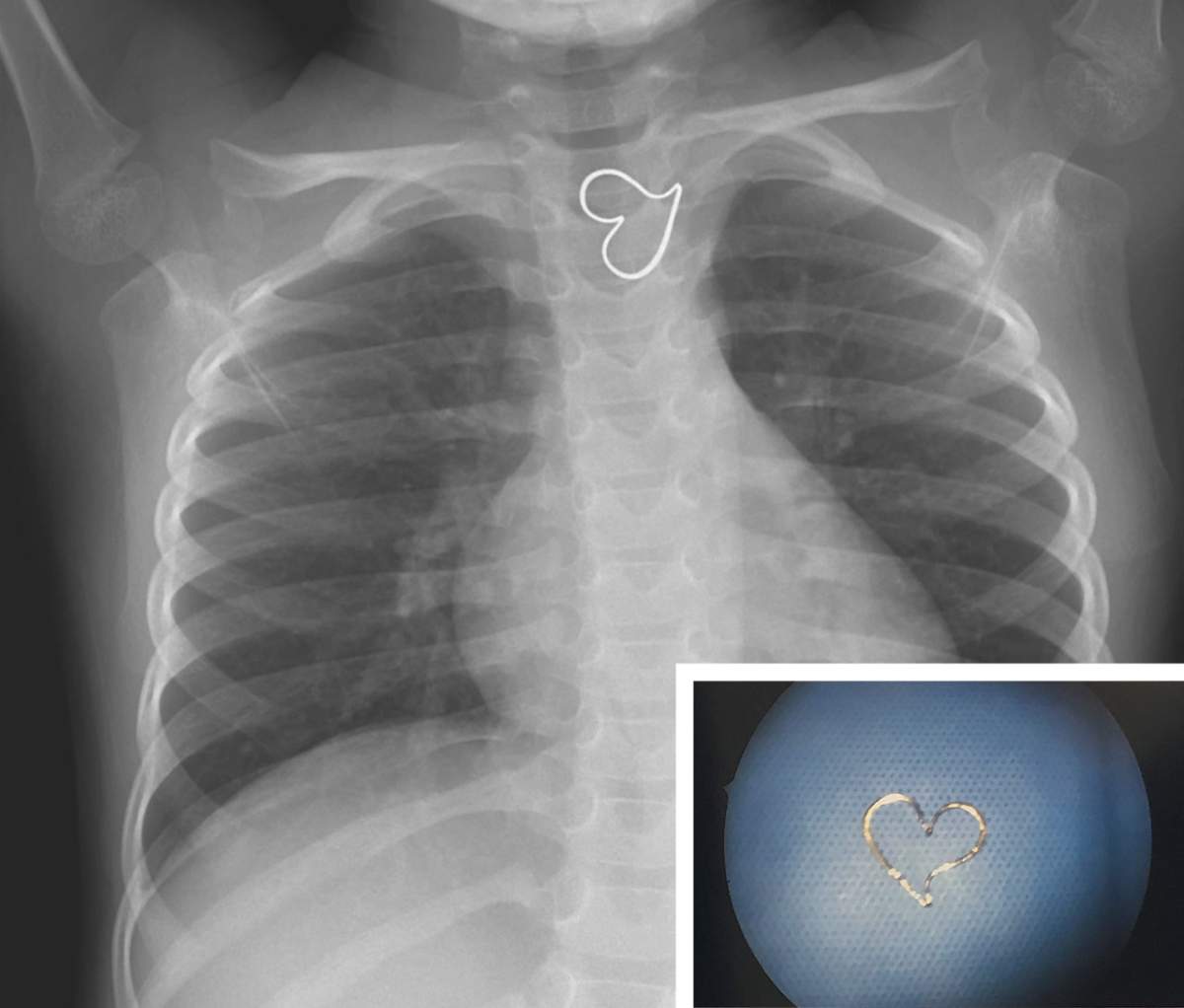An X-ray of a three-year-old girl, with a gold heart pendant stuck in her esophagus. And, the pendant.
