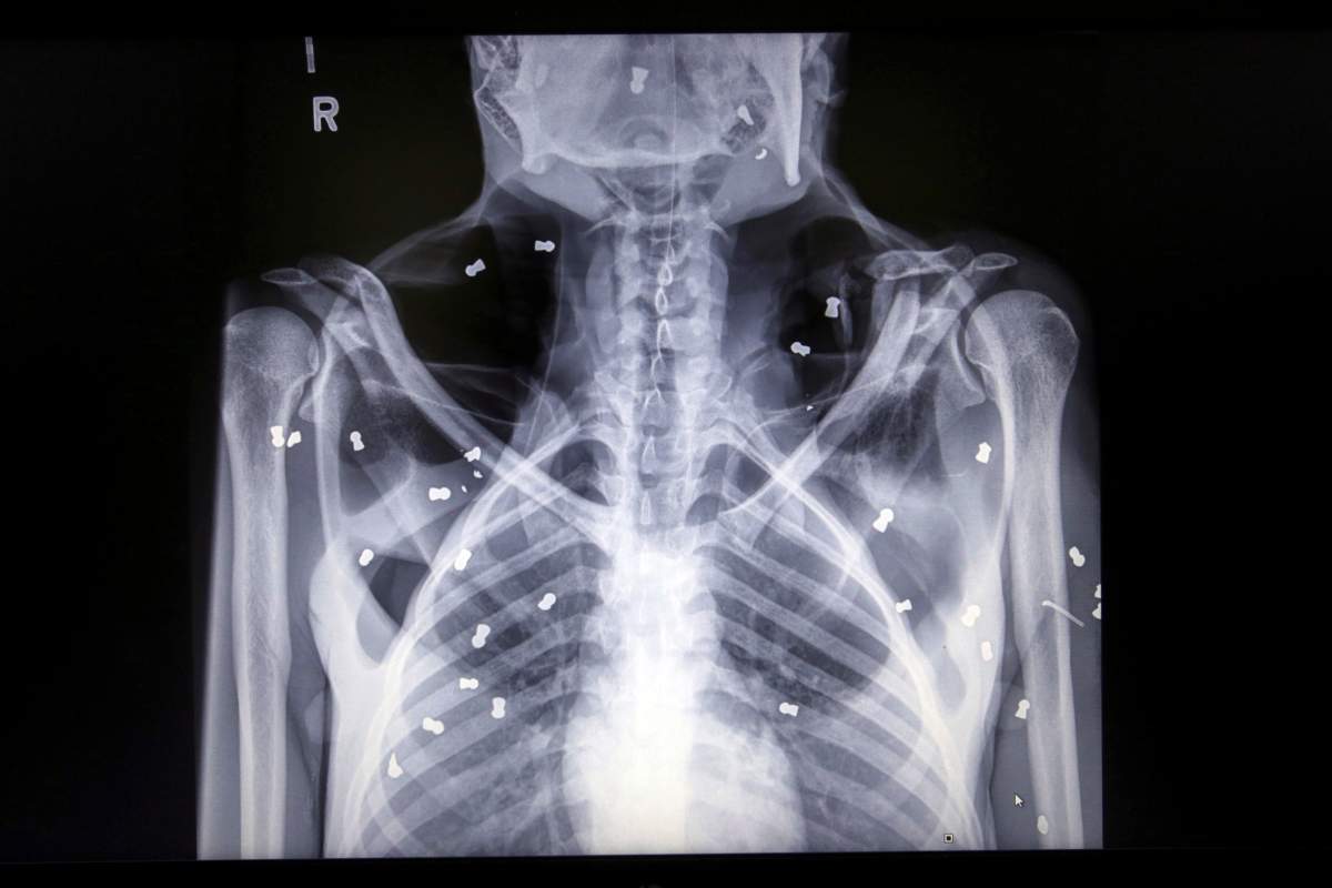 This Sunday, March 17, 2019 photo shows an X-ray image of air rifle pellets inside the body of a female orangutan named ‘Hope.’
