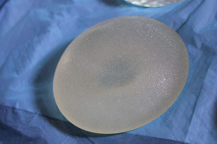 A textured breast implant.