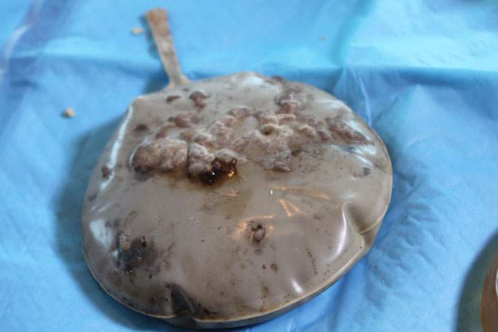 A defective breast implant, where the casing is flaking apart.