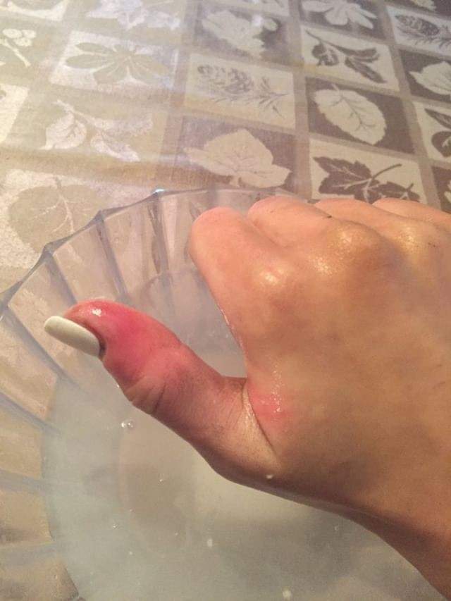 When melanoma hides: Woman develops skin cancer under her nail - image