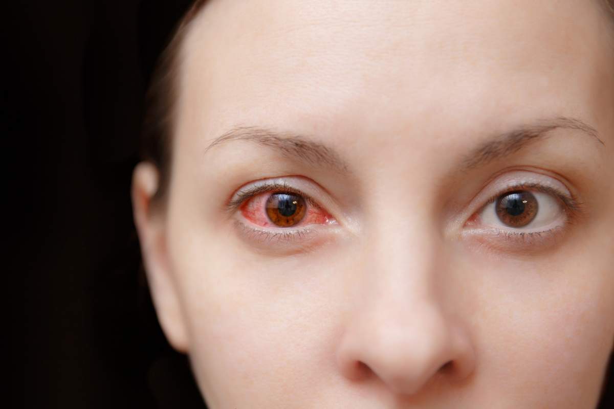 After almost losing her vision, woman urges contact lens users to be more alert - image