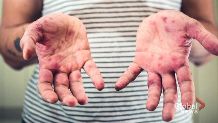 measles