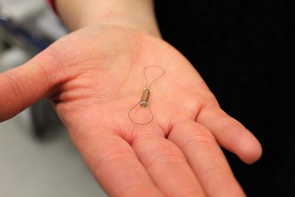 A CardioMEMS device is seen in this undated handout photo provided July 22, 2019. THE CANADIAN PRESS/HO, Dawn Smith, Libin Cardiovascular Institute of Alberta.
