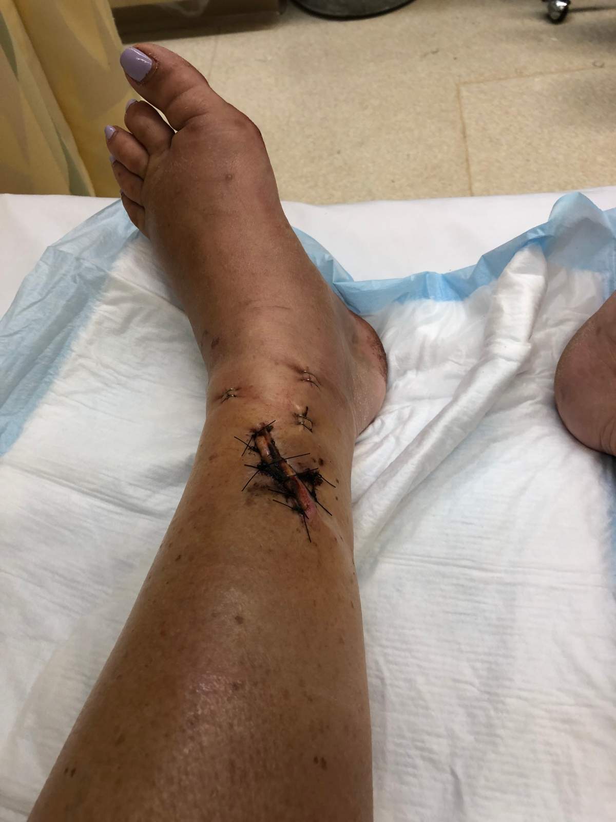 Francesca Galati’s leg shortly after receiving surgery on her broken tibia after being trampled during the Raptors parade.