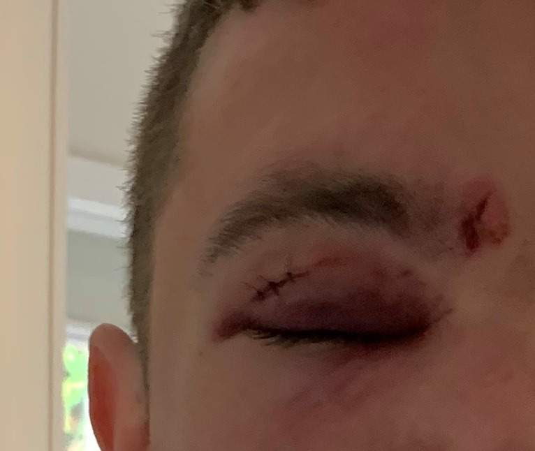 Stitches and bruising to Michele Becker's son's face, which she says is the result of a sucker punch last week. 