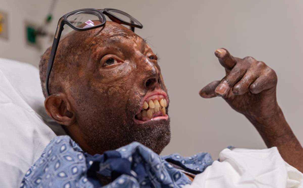 Chelsea’s car was hit by a drunk driver, causing a fire and leading to severe burns that left him significantly disfigured.
