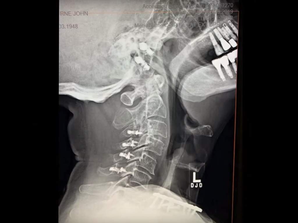 An x-ray scan of Ozzy Osbourne’s neck from 2019, after he suffered injuries from a fall in his Los Angeles, Calif., home in January.