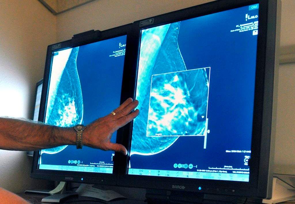 FILE - This July 31, 2012, file photo shows a mammogram, a test to detect cancer.